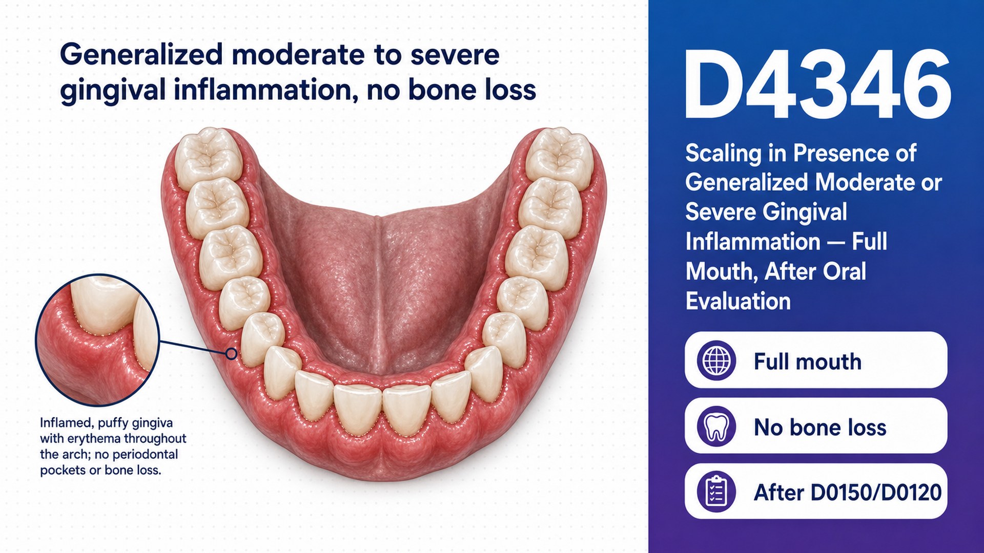 D4346 Scaling in Presence of Gingival Inflammation: Billing, Denials & How It Differs From D1110 and D4341 (2026)